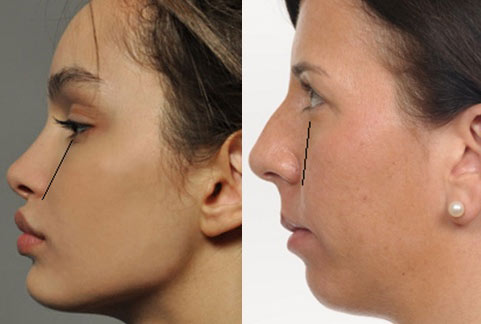 Разница между верхней губой и носом у обеих женщин